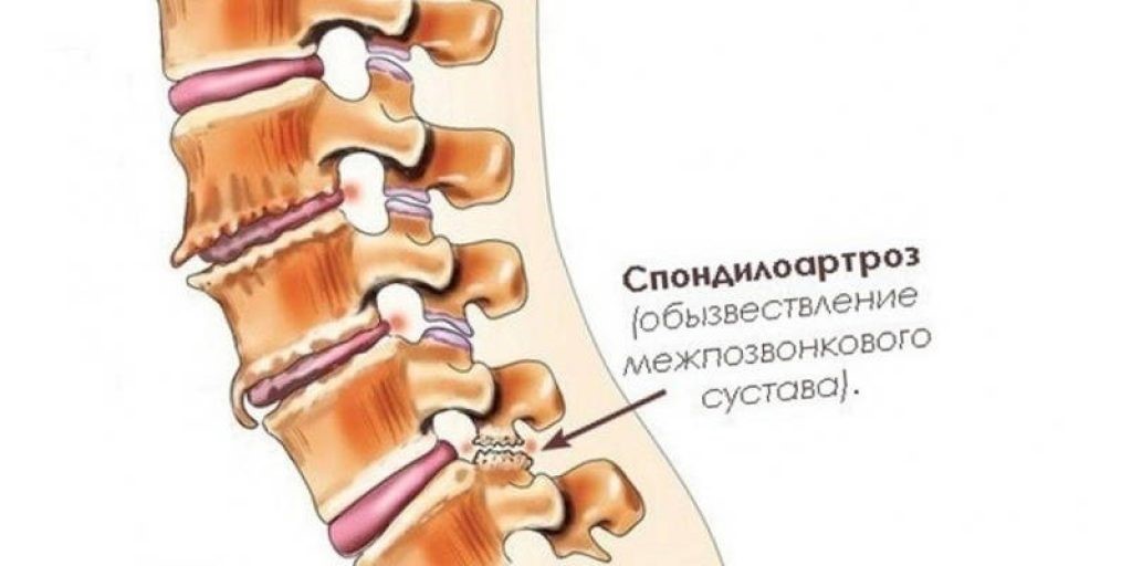 Спондилоартроз